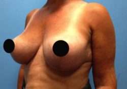 Breast Reduction