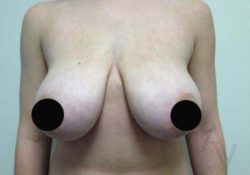 Breast Reduction