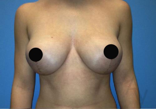 Breast Reduction