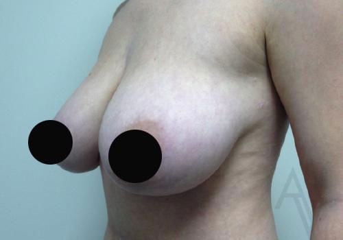 Breast Reduction