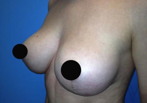 Breast Reduction