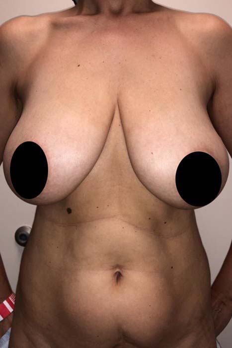 Breast Reduction Case 334 Before Photo Breast Reduction