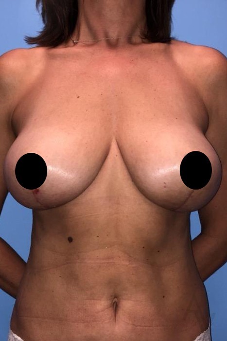 Breast Reduction Case 334 After Photo Breast Reduction