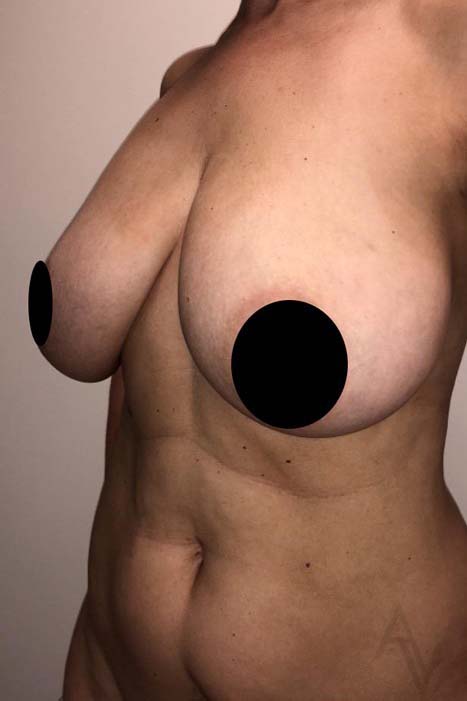 Breast Reduction