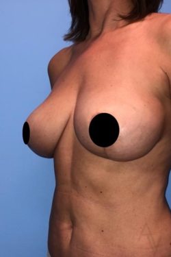 Breast Reduction