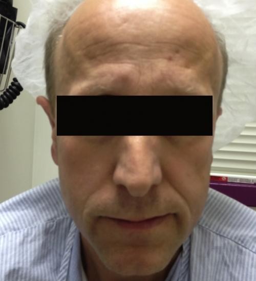 Ear Surgery Case 372 Before Photo Ear Surgery