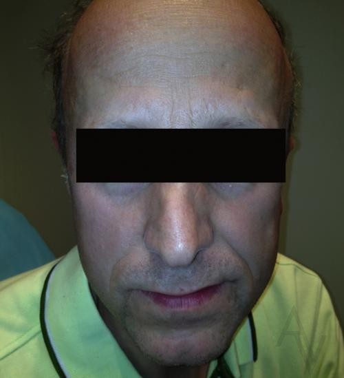 Ear Surgery Case 372 After Photo Ear Surgery
