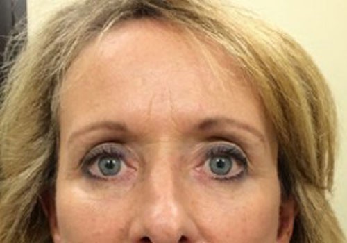 Eyelid Surgery by Dr. Golger in Toronto