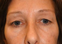 Eyelid Surgery