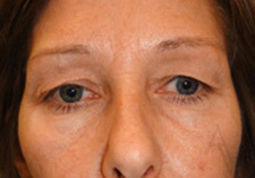 Eyelid Surgery Case 374 Before Photo Eyelid Surgery