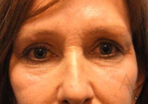 Eyelid Surgery Case 374 After Photo Eyelid Surgery