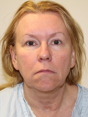 Face & Neck Lift Case 375 Before Photo Face & Neck Lift