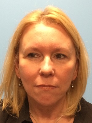 Face & Neck Lift Case 375 After Photo Face & Neck Lift