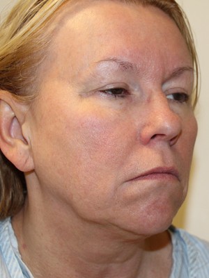 Facelift Before Image in Toronto