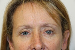 Face & Neck Lift Case 396 Before Photo Face & Neck Lift
