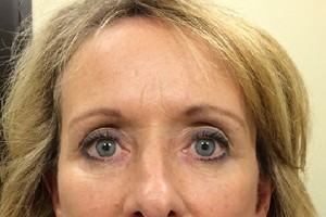 Face & Neck Lift Case 396 After Photo Face & Neck Lift