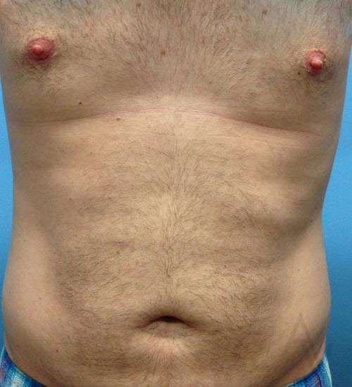 Liposuction