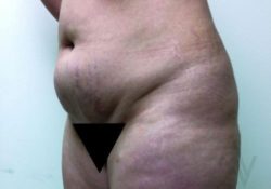 Liposuction