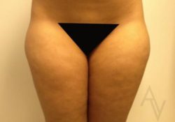 Liposuction