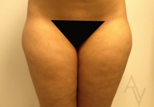 Liposuction Case 412 Before Photo Liposuction