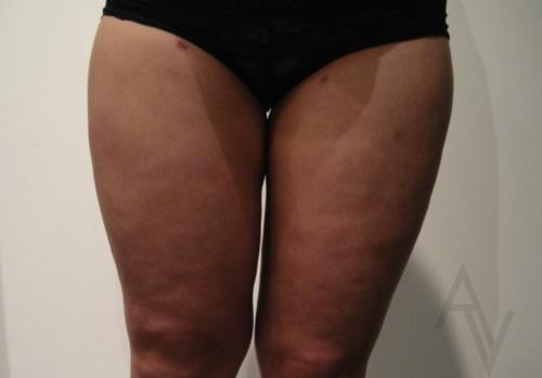 Liposuction Case 412 After Photo Liposuction