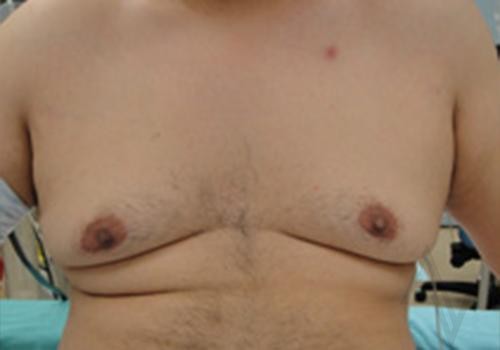 male breast reduction before and after photos by Toronto plastic surgeon Dr. Golger