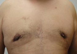 Male Breast Reduction