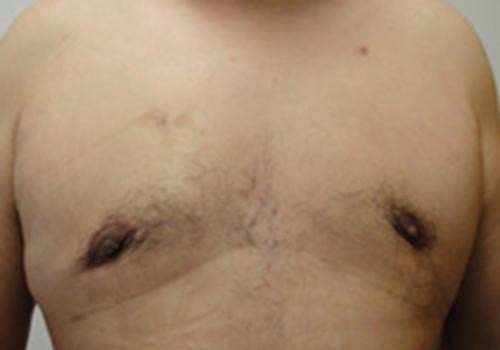 male breast reduction before and after photos by Toronto plastic surgeon Dr. Golger