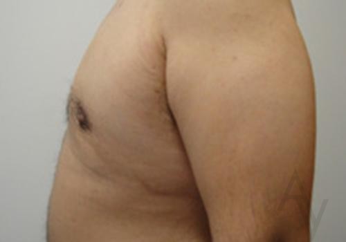 Male Breast Reduction