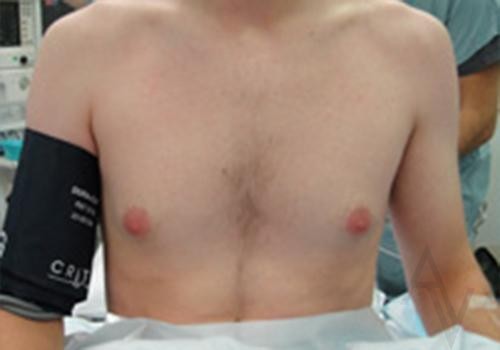 Male Breast Reduction Case 426 Before Photo Male Breast Reduction