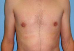 Male Breast Reduction