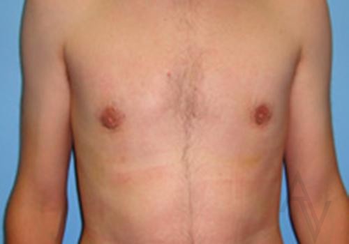 Male Breast Reduction Case 426 After Photo Male Breast Reduction