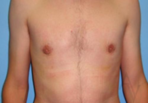 Male Breast Reduction