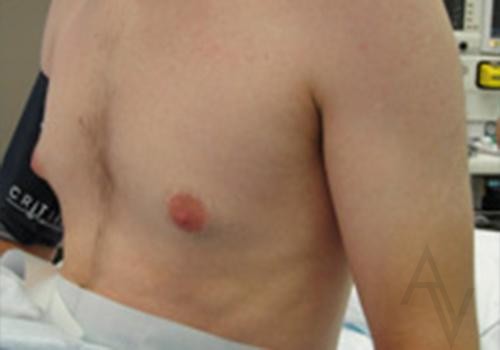 Male Breast Reduction