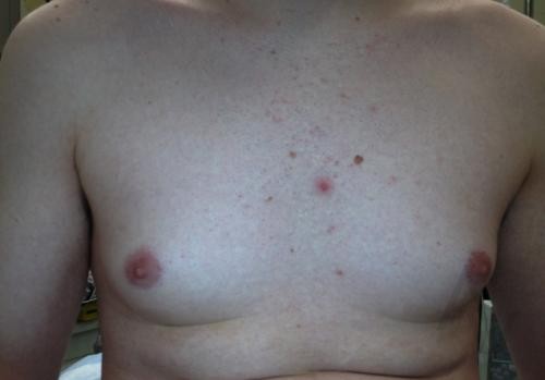 Male Breast Reduction Case 427 Before Photo Male Breast Reduction