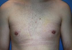 Male Breast Reduction