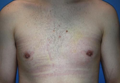 Male Breast Reduction Case 427 After Photo Male Breast Reduction
