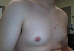 Male Breast Reduction