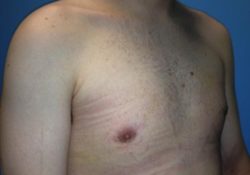 Male Breast Reduction