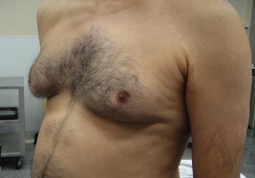 Male Breast Reduction Case 428 Before Photo Male Breast Reduction