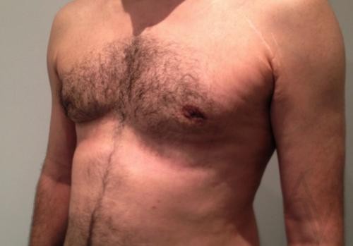 Male Breast Reduction Case 428 After Photo Male Breast Reduction