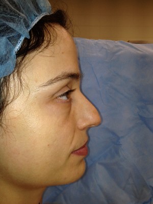 Rhinoplasty Case 458 Before Photo Rhinoplasty