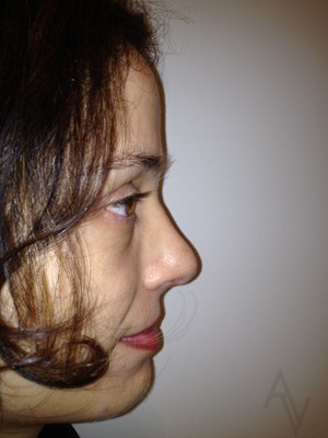 Rhinoplasty Case 458 After Photo Rhinoplasty