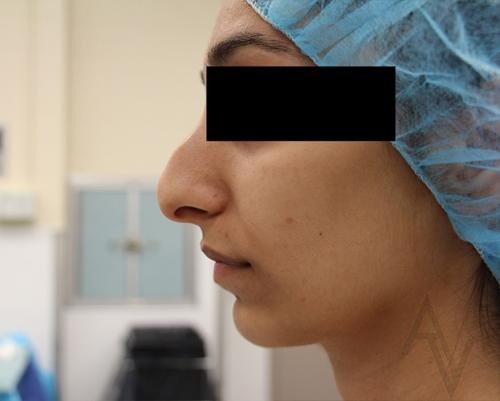 Rhinoplasty