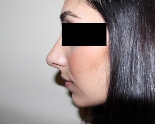 Rhinoplasty Case 459 After Photo Rhinoplasty