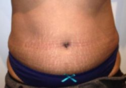 Tummy Tuck