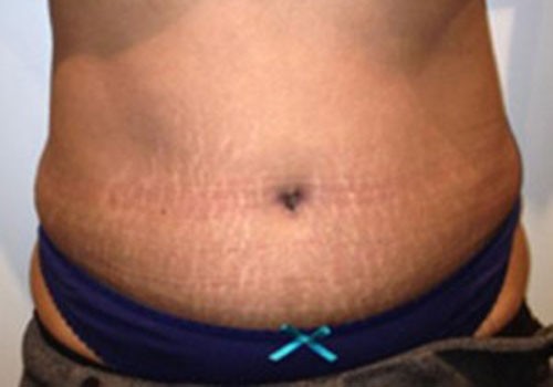 Tummy Tuck Case 464 After Photo Tummy Tuck