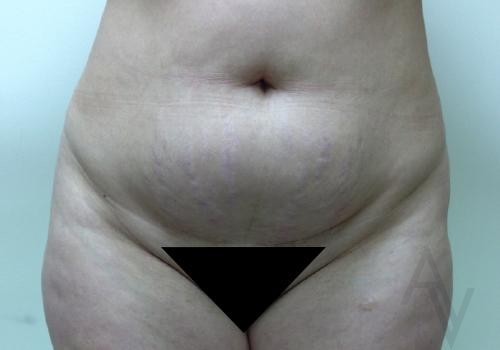 Tummy tuck before and after by Toronto plastic surgeon Dr. Golger