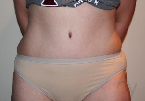 Tummy tuck before and after by Toronto plastic surgeon Dr. Golger
