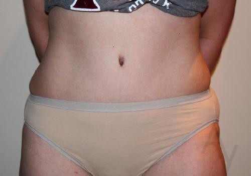 Tummy Tuck